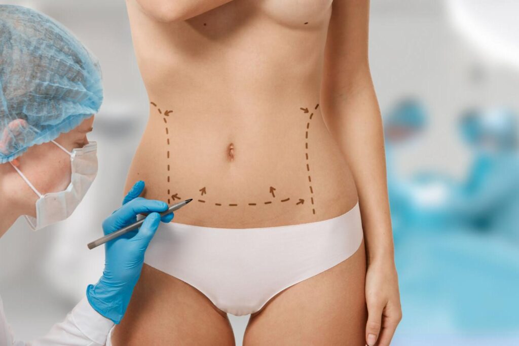 la liposuccion est une intervention de chirurgie esthétique complexe qui peut concerner de nombreuses zones du corps